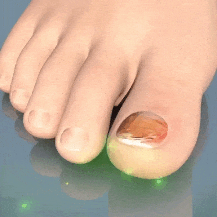 Benefits of Using Okita Nail Fungus Light