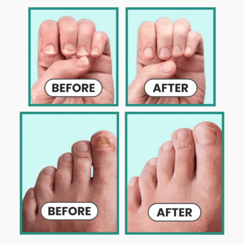 Dermablue (Upgraded Version [year]) - Official Retailer